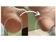 ピエモワ 表参道(PiEmoi)の雰囲気(かかとが一度でつるつるに たこ/かかとケア/ドイツ式フットケア)