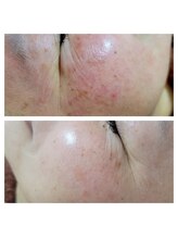 エスボーテ(sbeaute)/プラズマ+ララピール