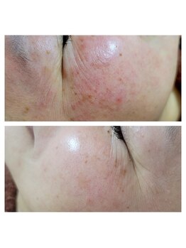 エスボーテ(sbeaute)/プラズマ+ララピール