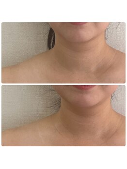 ポマイカイ 名古屋丸の内店(pomaikai)/首肩リンパケア