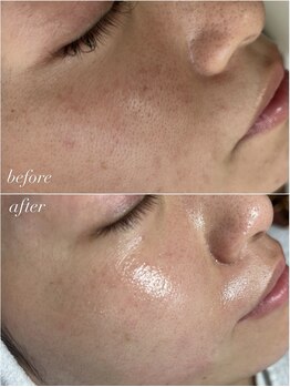 スパークル/毛穴/毛穴洗浄/ワックス脱毛