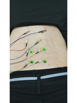 アイワ鍼灸整骨院/鍼灸　腰の通電