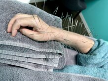 高宮レディース鍼灸整骨院/ルート鍼