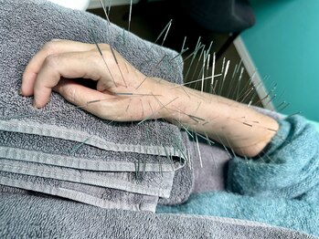 高宮レディース鍼灸整骨院/ルート鍼