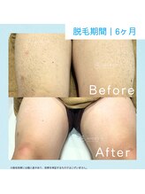 メンズクリア 渋谷明治通り店/【メンズクリア】お客様の施術例