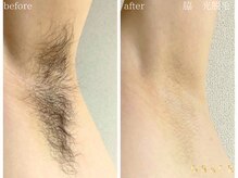 グレイス 久留米店(GRACE)/脇　光脱毛