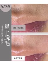 ウィズマツオカ 光の森店/口周り脱毛(6回)効果写真