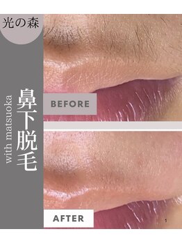 ウィズマツオカ 光の森店/口周り脱毛(6回)効果写真