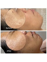 カノン(Kanon)/眼尻のこじわ