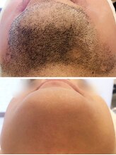 トゥエイト(to 8..)/WAX脱毛 ヒゲ