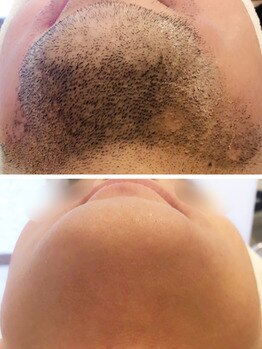 トゥエイト(to 8..)/WAX脱毛 ヒゲ