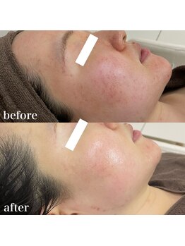 リニューサロン 本院(renew salon)/赤みや肌荒れでお悩みの方に