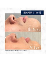 メンズクリア いわき店/【メンズクリア】お客様の施術例