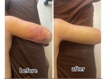 インディバジェム(GEM)/ビフォーアフター