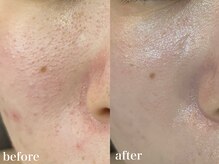 ホワイトアクア 北千住店(WHITE AQUA)/ハーブピーリング