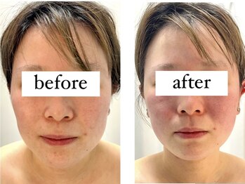 ラヴィアンローズ 忠節店(La vie en Rose)/コルギ矯正 before→after