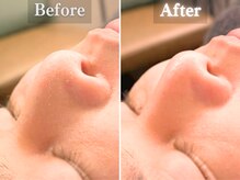 ボーンオム(Born Homme)/毛穴洗浄＋美容液導入：20代男性