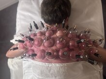 ユラン(YURAN)の雰囲気（皆さんに大人気のカッピング！ふっと軽くなるお身体へ。）