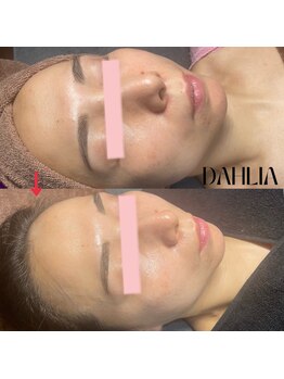 ダリア(Dahlia)/ハーブピーリング