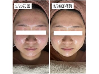 アルムダアクア 天王寺店(Aleumda AQUA)/ハーブピーリング/大阪/天王寺