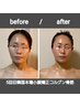【当店人気NO１】美容大国韓国で 唯一証明されたとにかく小顔コルグンセラピ