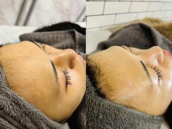 シード(SHE°)/ハーブピーリング