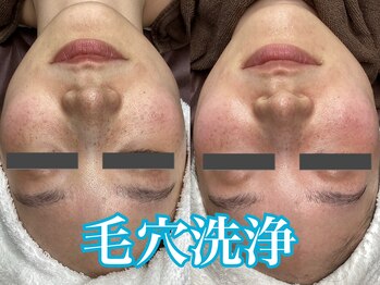 マルサンカクシカク(○△□)/毛穴洗浄