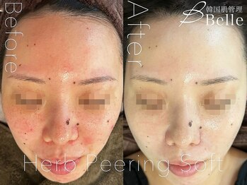ベル 札幌(Belle)/ハーブピーリング｜毛穴ケア