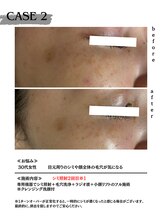 ミウル 天王寺店(miulu)/30代女性/シミ照射2回