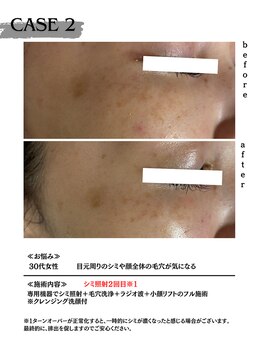 ミウル 天王寺店(miulu)/30代女性/シミ照射2回