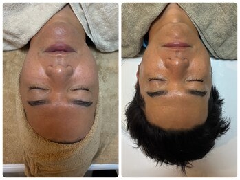 フォルスボーテ(Force Beaute)/グロッティープロで肝細胞導入！