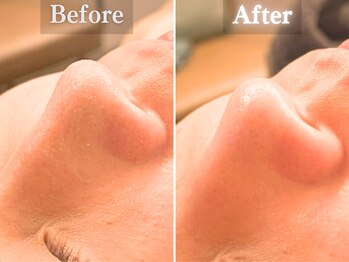 ボーンオム(Born Homme)/毛穴洗浄＋美容液導入：30代女性