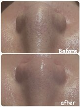 サロンドビジュー(salon de bijou)/フラワーハーブピーリング×毛穴