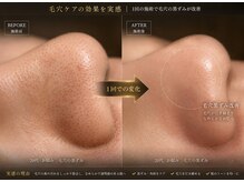 ポノ 甲府本店(pono)/毛穴にょきにょき