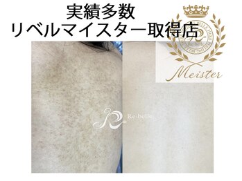 フロージア 新宿南口店(FLOGIEIA)/小顔ハーブピーリングフロージア