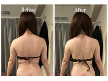 ハリムーン 仙台(harimoon)/背中・脇ビフォーアフター