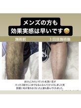 アイルハイパースキン/メンズ脱毛全身ヒゲVIO込み