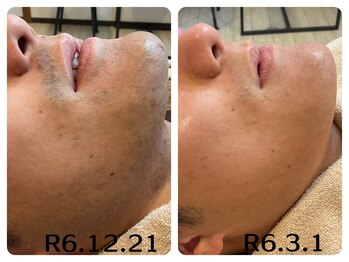 フィズ 五日市彩が丘店(FIS)/☆美肌脱毛☆髭脱毛