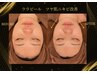 ★平日予約限定★【ララピール×リフティング小顔＆毛穴洗浄】￥16,500