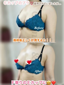 カルマーアンドビー(Calmer & Be.)/【バスト】Before/After