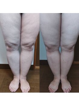 インディバサイタマックス(INDIBA SAITAMAX)/浮腫み　その2