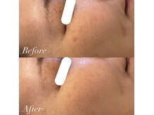 ジル(JilL)の雰囲気（ダクトピールは透明感UP、シミケアに◎毛穴レスな美肌へ♪）