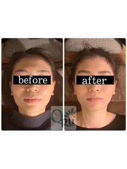 キュープ 静岡店(Qpu)の写真/まずはお試しに!【歪み&左右差特化】小顔矯正×リンパケア8800→6600★圧倒的効果で自分史上最高の小顔へ