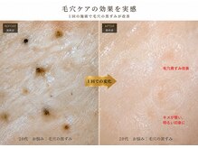 ポノ 甲府本店(pono)/毛穴にょきにょき