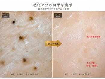 ポノ 甲府本店(pono)/毛穴にょきにょき