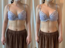 タオ(TAO)/バストアップ症例