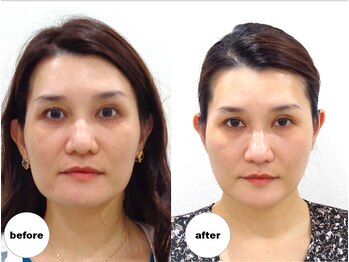 グランルーツ(GranRoots)/小顔矯正before/after