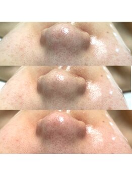 ミモ(MIMO)の写真/韓国発♪毛穴開き・黒ずみ・ゴワつき等のお悩み徹底改善！毛穴洗浄+ヒト幹細胞コスメトリートメント¥6980☆
