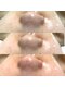 ミモ(MIMO)の写真/韓国発♪毛穴開き・黒ずみ・ゴワつき等のお悩み徹底改善！毛穴洗浄+ヒト幹細胞コスメトリートメント¥6980☆