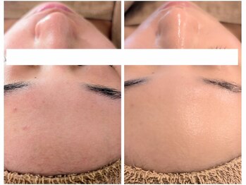 アン(anne)/剥離なしハーバルメソッド×5回